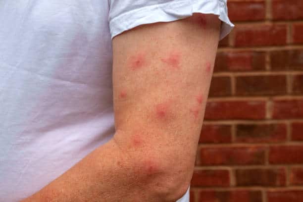 A mature man dressed in a t shirt displays a strong reaction to the mosquito bites on his bare arm