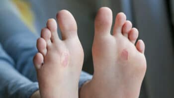 How Long Does It Take For A Blister To Heal And Why? How to Prevent & Treat It