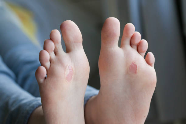 A close-up view on the underside of a human foot. Details of the dead skin from a large healing blister. Hurt or injured feet after a long walk.