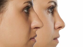 How Long Does a Rhinoplasty Take & What to Expect During Recovery