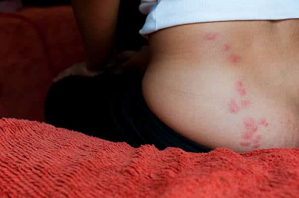 Itchy bed bug bites on a woman's lower back and buttocks