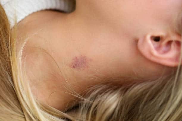 How Long Does It Take for a Hickey To Fade?