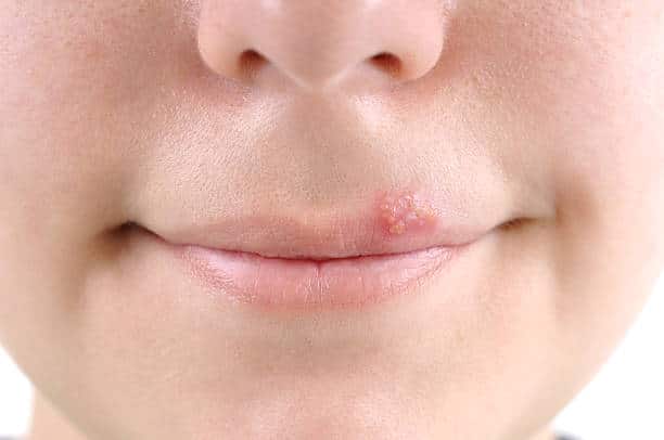 How Long After a Cold Sore Can You Kiss?